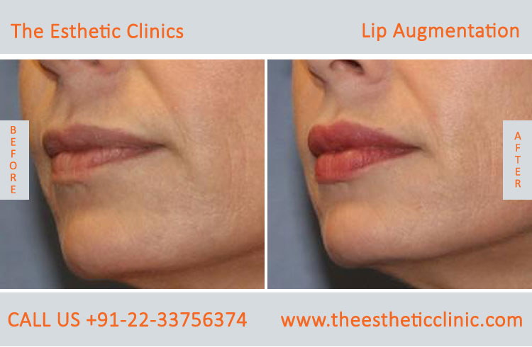 Lip Augmentation, Lip Enlargement, Lip Implant Surgery before after photos in mumbai india (6)